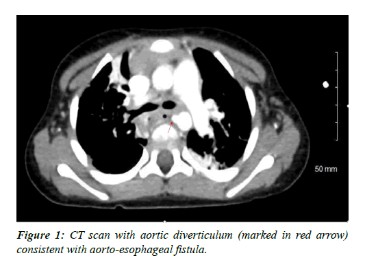 cardiovascular-thoracic-surgery-aortic-diverticulum