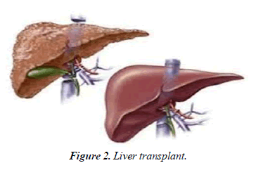 Cancer-Clinical-transplant