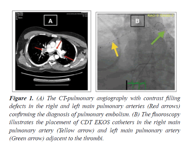 cardiovascular-thoracic-surgery-contrast-filling