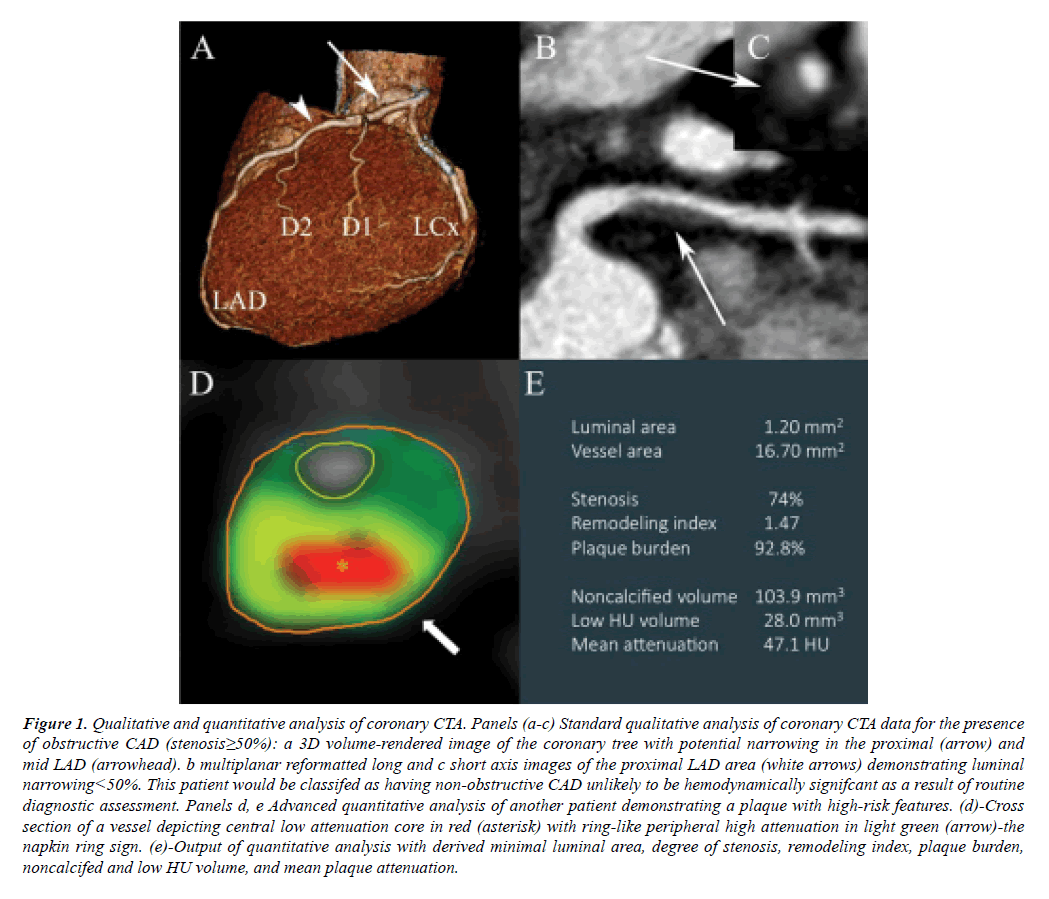 cardiovascular-thoracic-surgery-coronary-CTA