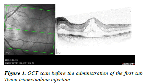 clinical-ophthalmology-Tenon