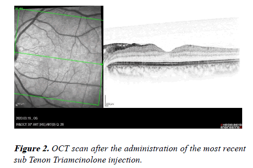 clinical-ophthalmology-Triamcinolone