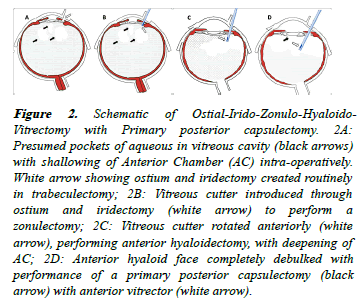 clinical-ophthalmology-Vitrectomy