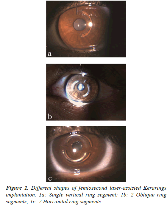 clinical-ophthalmology-femtosecond