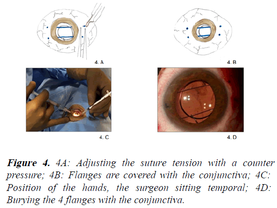 clinical-ophthalmology-suture