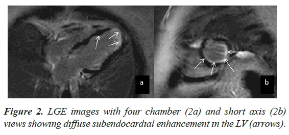 current-cardiology-subendocardial