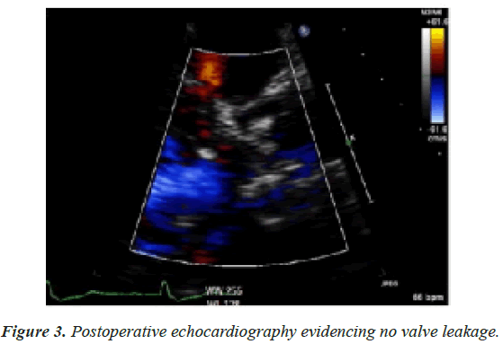 current-cardiology-valve