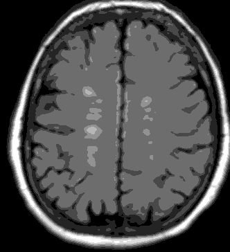 current-pediatric-hyperintensities