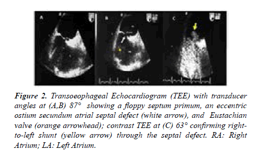 current-trends-cardiology-Transoeophageal