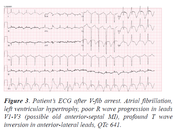 fibrillation