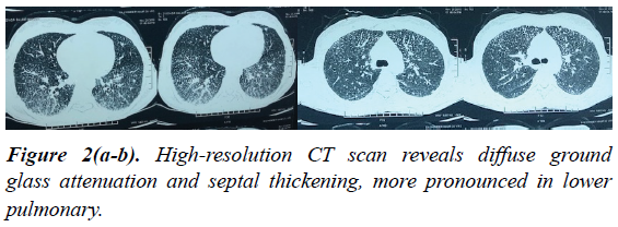 international-respiratory-medicine-attenuation