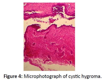 otolaryngology-online-journal-hygroma