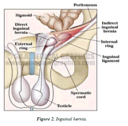 Asian-Biomedical-Inguinal