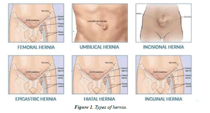Asian-Biomedical-hernia