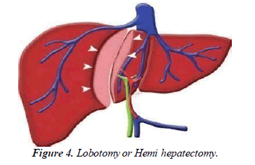 Cancer-Clinical-hepatectomy