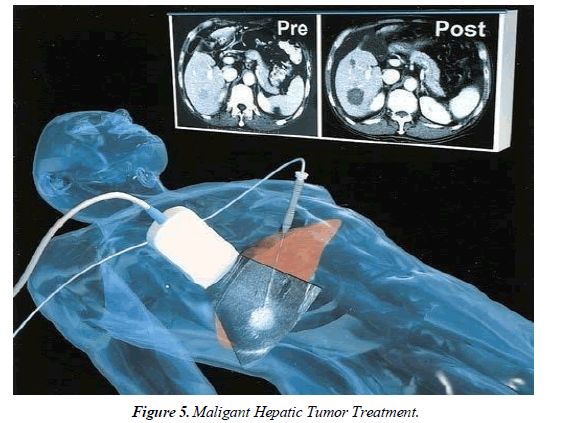 Cancer-Clinical-hepatectomy