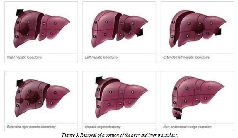 Cancer-Clinical-transplant