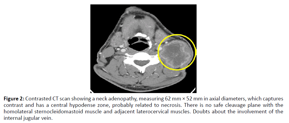 Otolaryngology-adenopathy