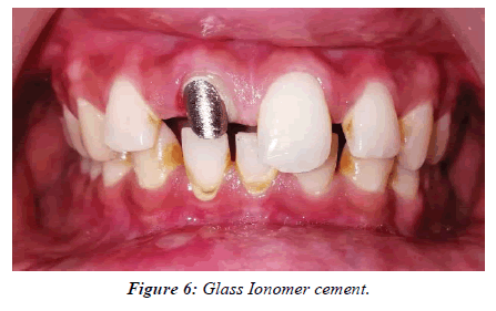 clinical-dentistry-Ionomer