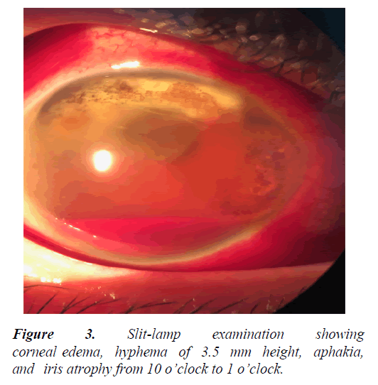 clinical-ophthalmology-hyphema