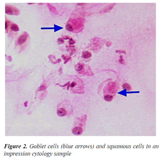 clinical-squamous