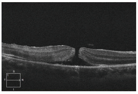 OER-axis