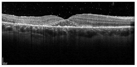 OER-macula