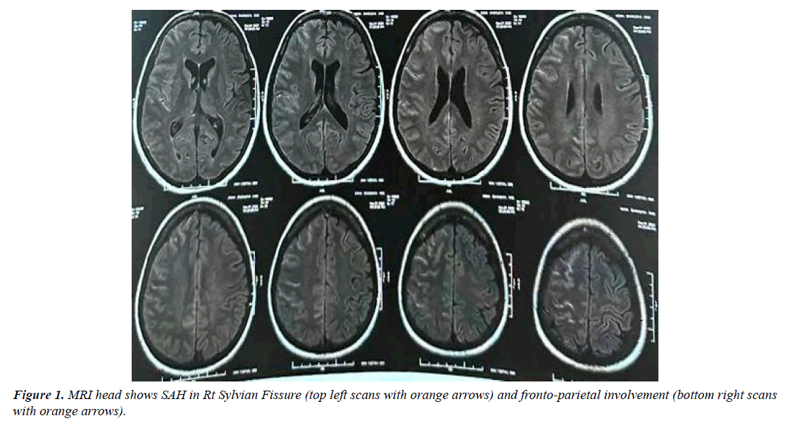 archives-general-internal-medicine-fronto-parietal-involvement