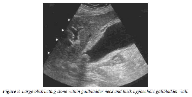 archives-general-internal-medicine-gallbladder-wall-thickness