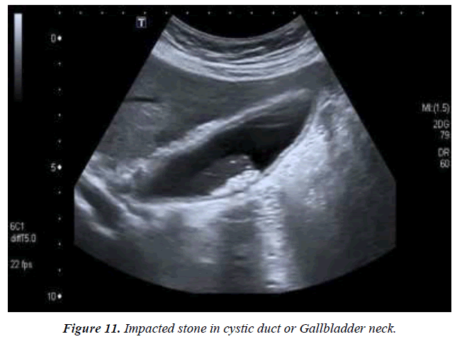 archives-general-internal-medicine-gallbladder-wall-thickness