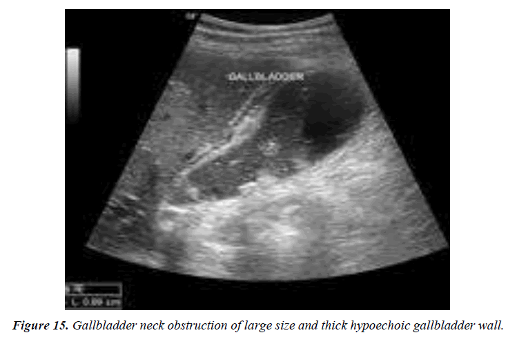 archives-general-internal-medicine-gallbladder-wall-thickness