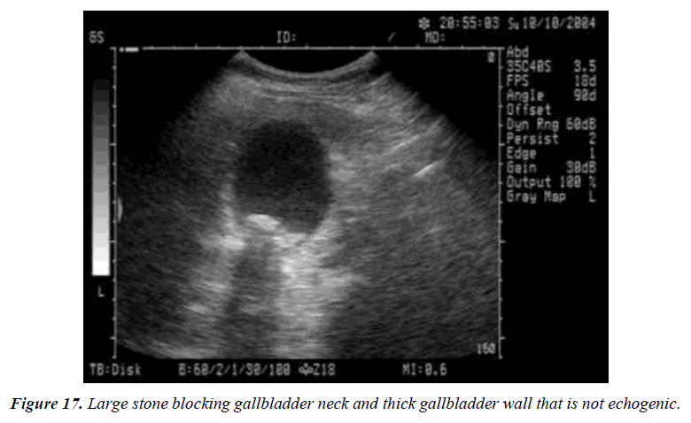 archives-general-internal-medicine-gallbladder-wall-thickness