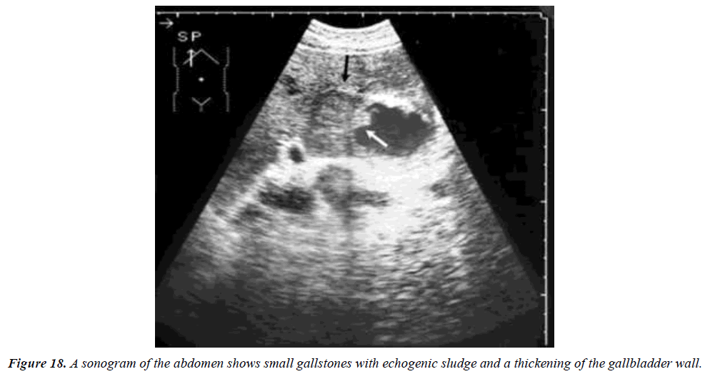 archives-general-internal-medicine-gallbladder-wall-thickness