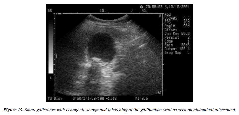 archives-general-internal-medicine-gallbladder-wall-thickness