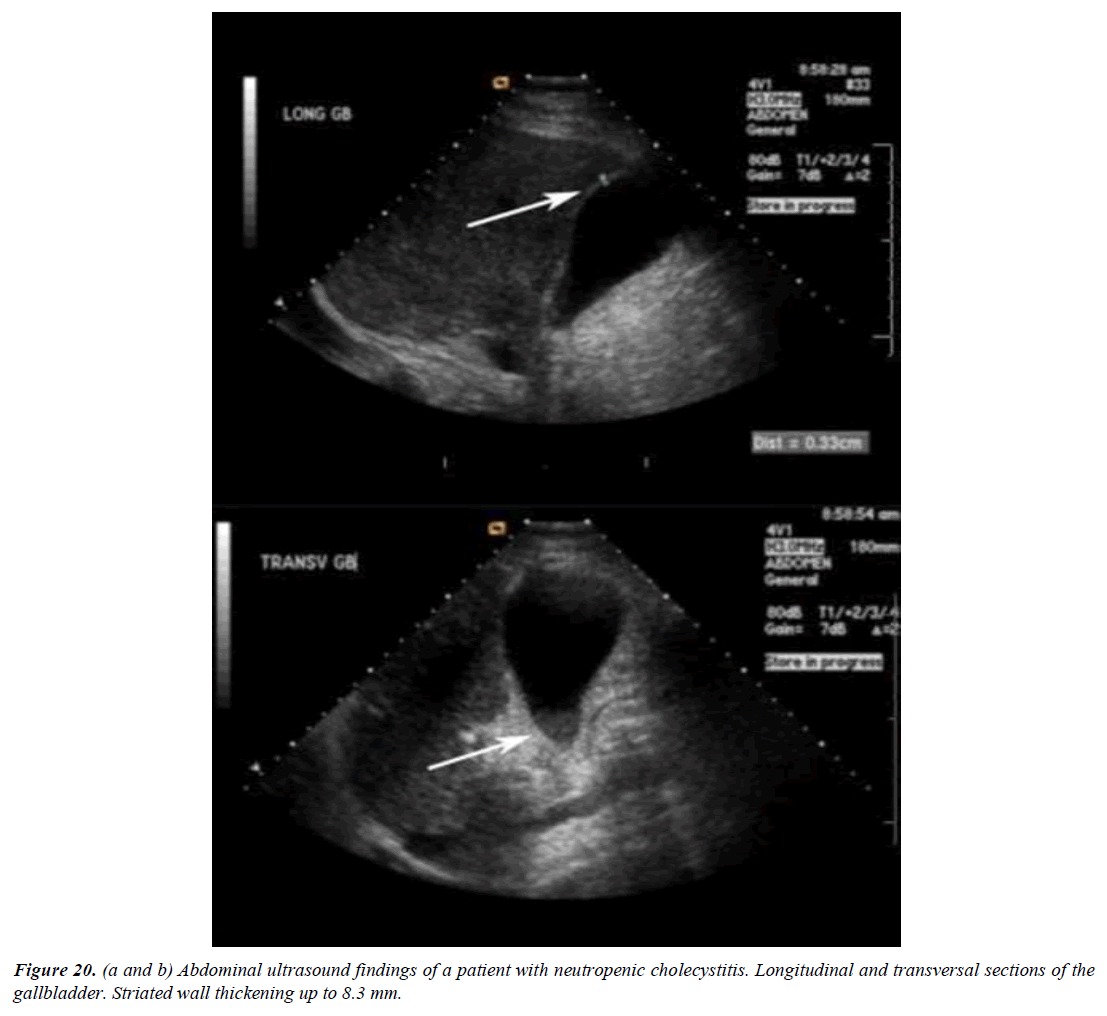 archives-general-internal-medicine-gallbladder-wall-thickness