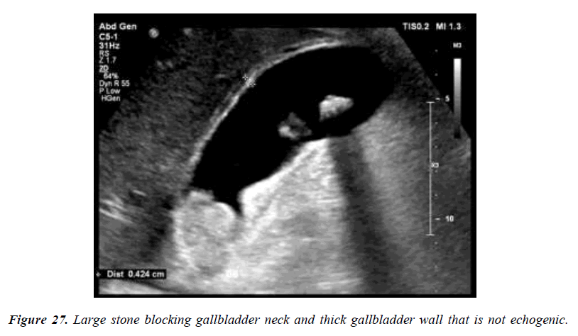 archives-general-internal-medicine-gallbladder-wall-thickness