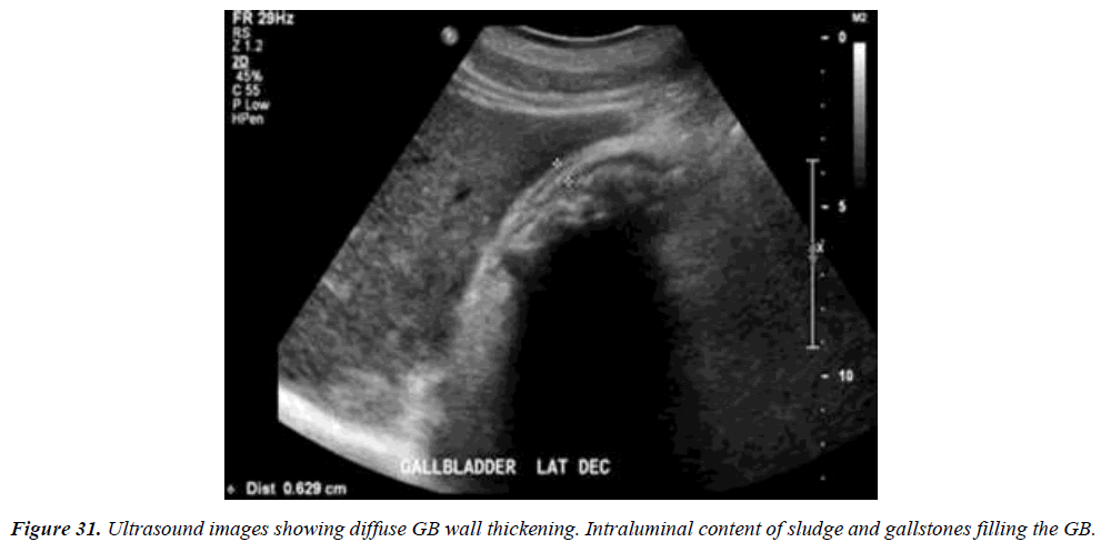 archives-general-internal-medicine-gallbladder-wall-thickness