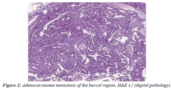 clinical-pathology-laboratory-medicine-adenocarcinoma-metastasis