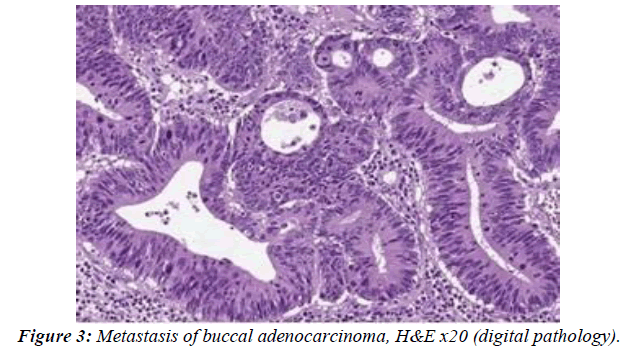 clinical-pathology-laboratory-medicine-adenocarcinoma-metastasis