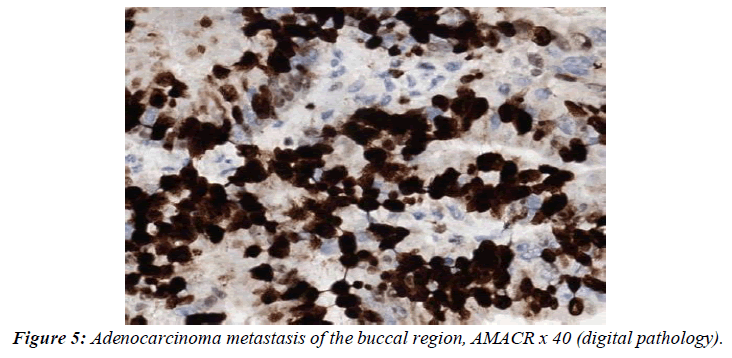 clinical-pathology-laboratory-medicine-adenocarcinoma-metastasis