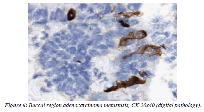 clinical-pathology-laboratory-medicine-adenocarcinoma-metastasis