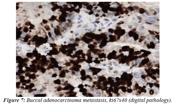 clinical-pathology-laboratory-medicine-adenocarcinoma-metastasis