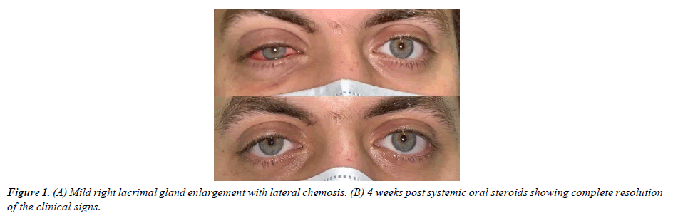 ophthalmic-and-eye-research-lateral-chemosis