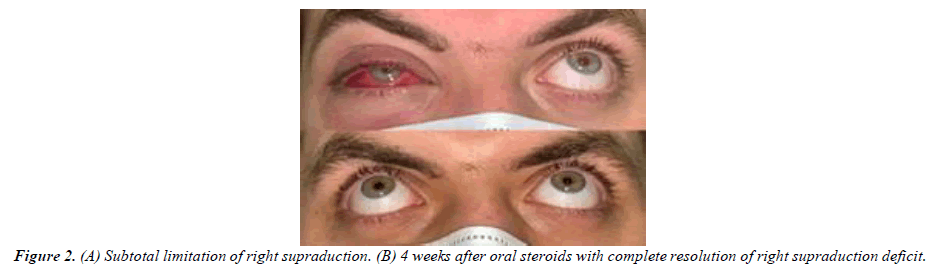 ophthalmic-and-eye-research-lateral-chemosis