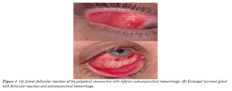 ophthalmic-and-eye-research-lateral-chemosis