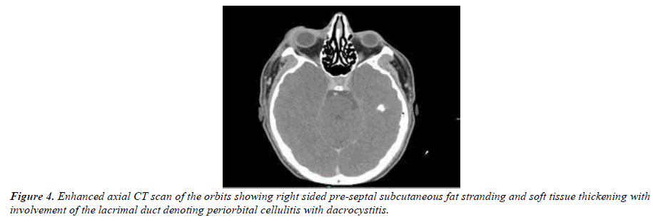 ophthalmic-and-eye-research-lateral-chemosis