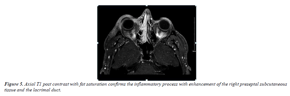 ophthalmic-and-eye-research-lateral-chemosis