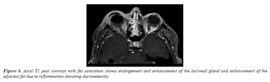 ophthalmic-and-eye-research-lateral-chemosis