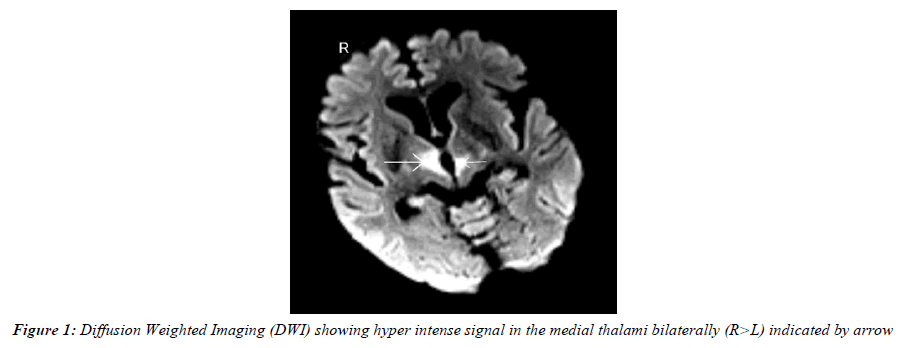 ophthalmic-and-eye-research-medial-thalami-bilaterally