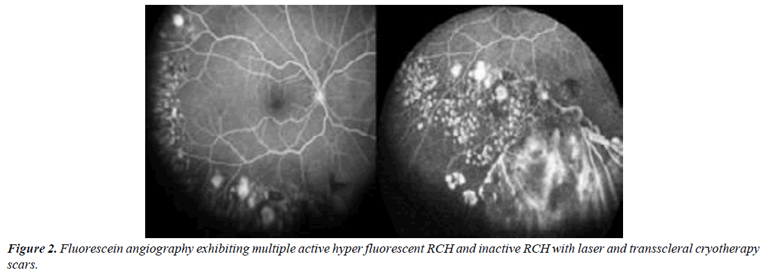 ophthalmic-and-eye-research-photocoagulated